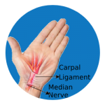 Carpal Tunnel Syndrome - Dr Naveen Reddy