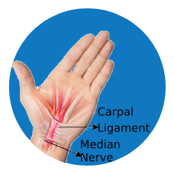 Carpal Tunnel Syndrome - Dr Naveen Reddy